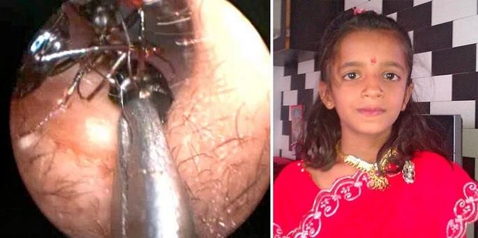 Mais de mil formigas foram retiradas do ouvido de uma criança indiana